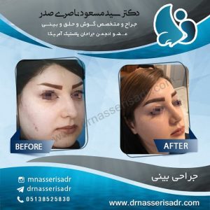 جراحی بینی