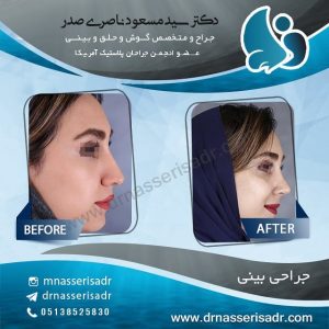 عکس قبل و بعد جراحی بینی از زاویه و نیم رخ راست