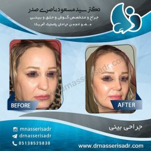 جراحی بینی