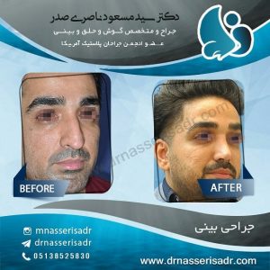 نمونه بین استخوانی و کج مردانه و نتیجه آن بعد از عمل