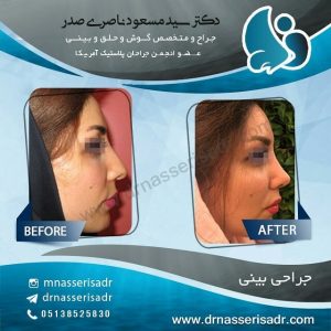 جراحی بینی
