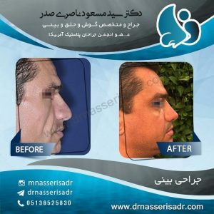 نمونه بینی استخوانی عمل شده از نیم رخ راست
