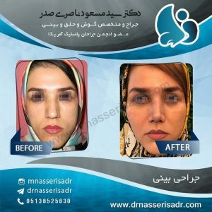 جراحی بینی