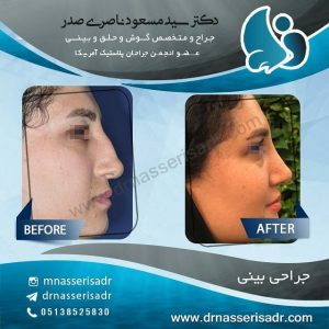 جراحی بینی