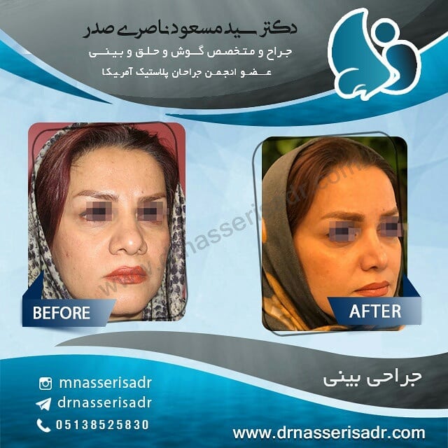 نمونه بینی گوشتی زنانه از تمام رخ
