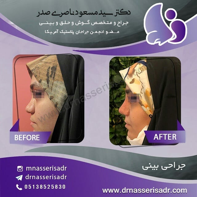 عکس عمل بینی گوشتی از نیم رخ چپ