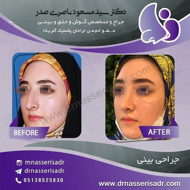 جراحی بینی استخوانی خانم جوان