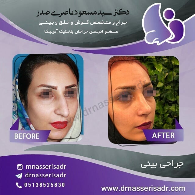 جراحی بینی استخوانی زنانه