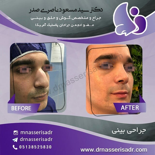 جراحی بینی استخوانی آقای جوان