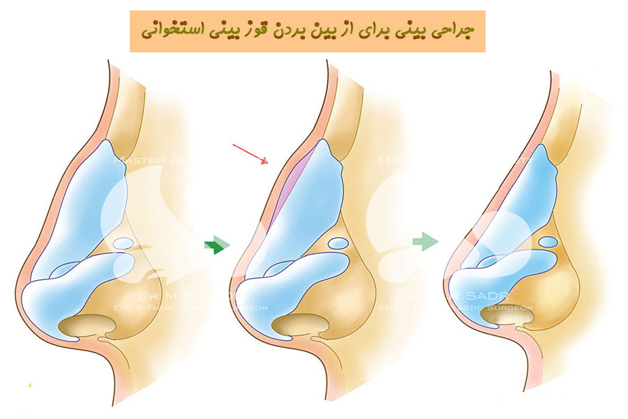 ویژگی های بینی استخوانی