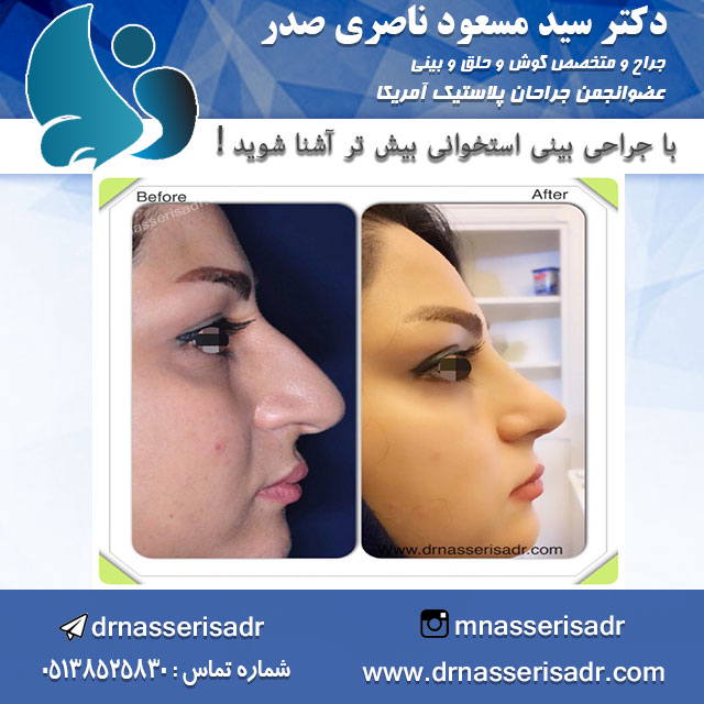 آشنایی با جراحی بینی استخوانی