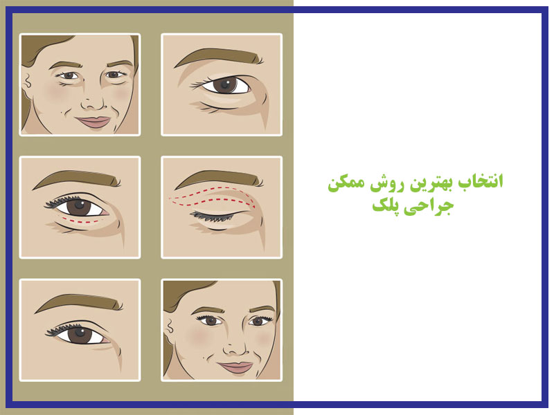 انتخاب بهترین روش ممکن برای جراحی پلک