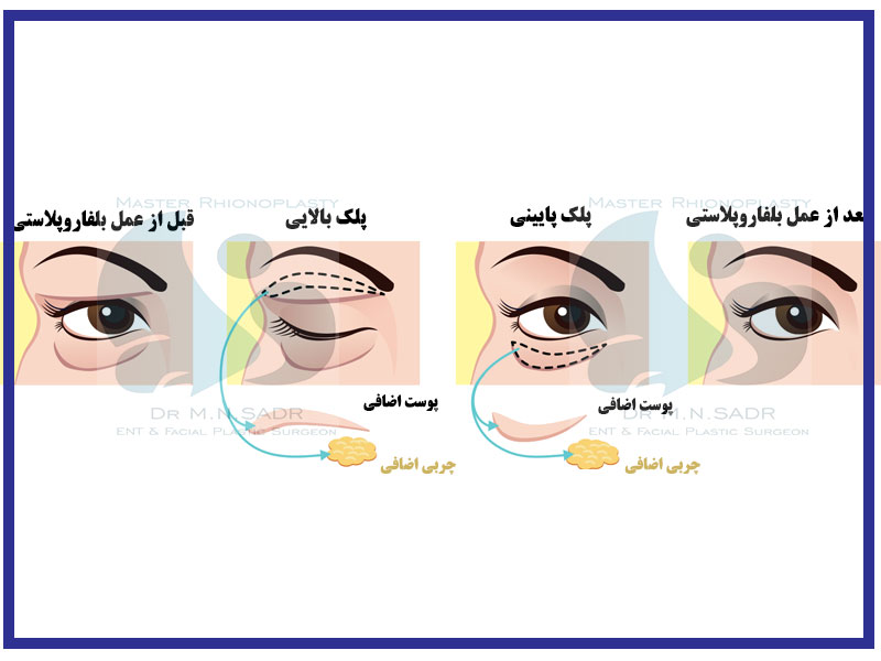 بلفاروپلاستی چیست؟
