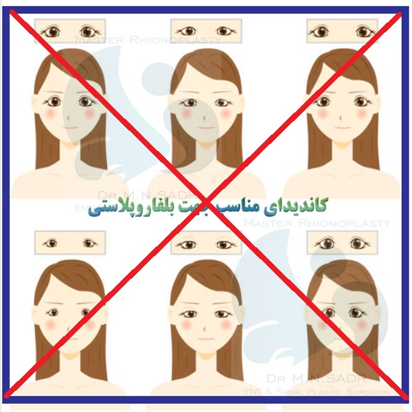 کاندیدای نامناسب برای بلفاروپلاستی