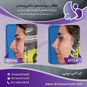 جراحی بینی استخوانی بعد از عمل