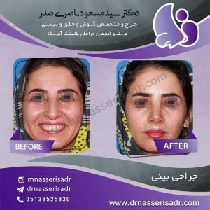 جراحی بینی زنانه از زو به رو