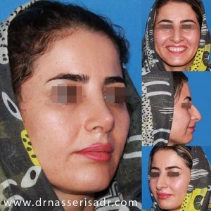 نمونه عمل بینی دخترانه از تمام رخ ها