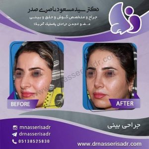 نمونه عمل بینی قبل و بعد