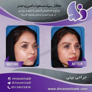 جراحی بینی از رخ راست