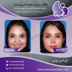جراحی بینی پهن بعد از عمل