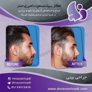 نتیجه عمل انحراف بینی در آقای جوان بعد از 6 ماه از نیم رخ راست