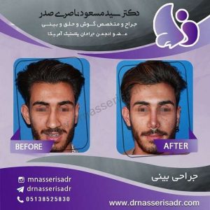 نتیجه عمل انحراف بینی در آقای جوان بعد از 6 ماه تمام رخ