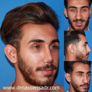 نتیجه عمل انحراف بینی در آقای جوان بعد از 6 ماه در تمامی رخ ها