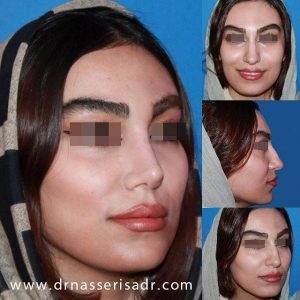 نمونه عمل بینی استخوانی از تمامی رخ ها