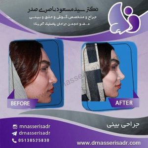 نمونه عمل بینی استخوانی از نیم رخ راست