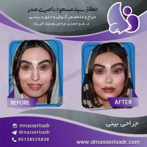 نمونه عمل بینی استخوانی تمام رخ