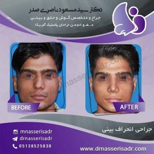 نمونه عمل بینی بعد از 10 روز با انحراف بینی
