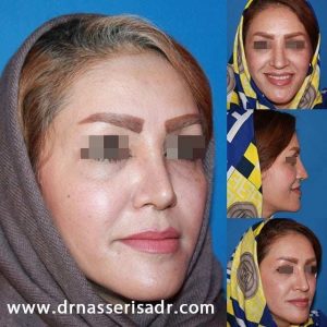 نمونه قبل و بعد از رینوپلاستی بعد از سه ماه - نیم رخ چپ