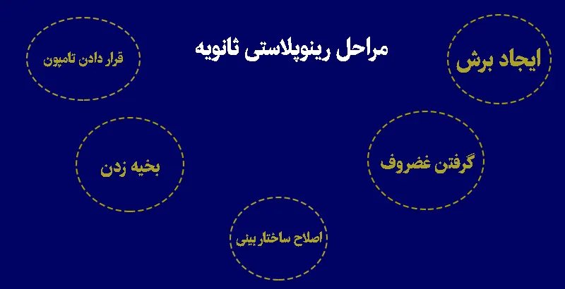 مراحل جراحی بینی ثانویه