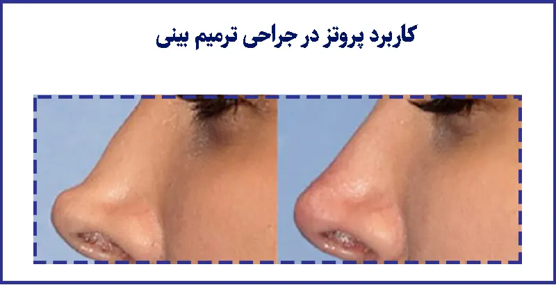 کاربرد پروتز