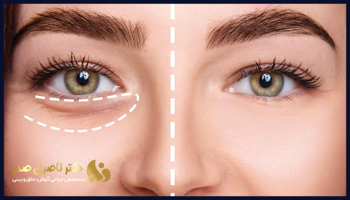 مزایای تزریق فیلر زیر چشم