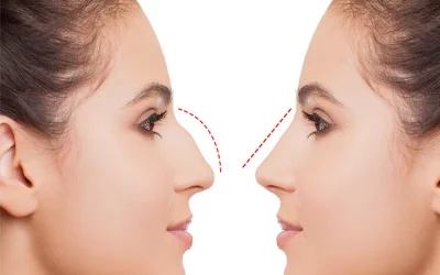 جراحی قوز بینی در مشهد