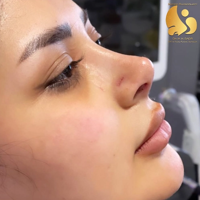 نمونه جراحی بینی نمیه فانتزی دکتر ناصری صدر