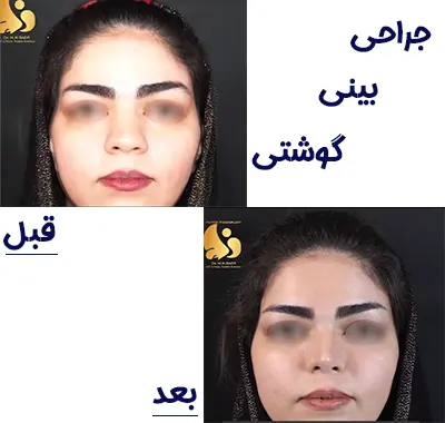 نمونه کار جراحی بینی گوشتی بهترین جراح بینی در مشهد