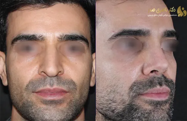 نمونه کار جراحی بینی مردانه