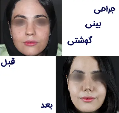 نمونه کار عمل بینی گوشتی بهترین جراح بینی در مشهد