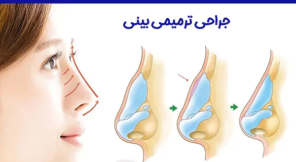 جراحی ترمیمی بینی