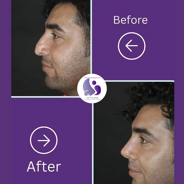 نمونه کار جراحی بینی استخوانی دکتر ناصری صدر 
