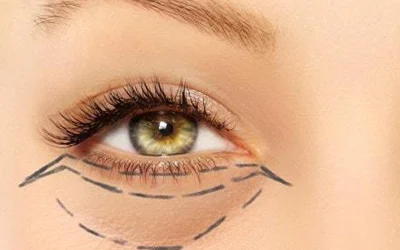 جراحی پلک پایین