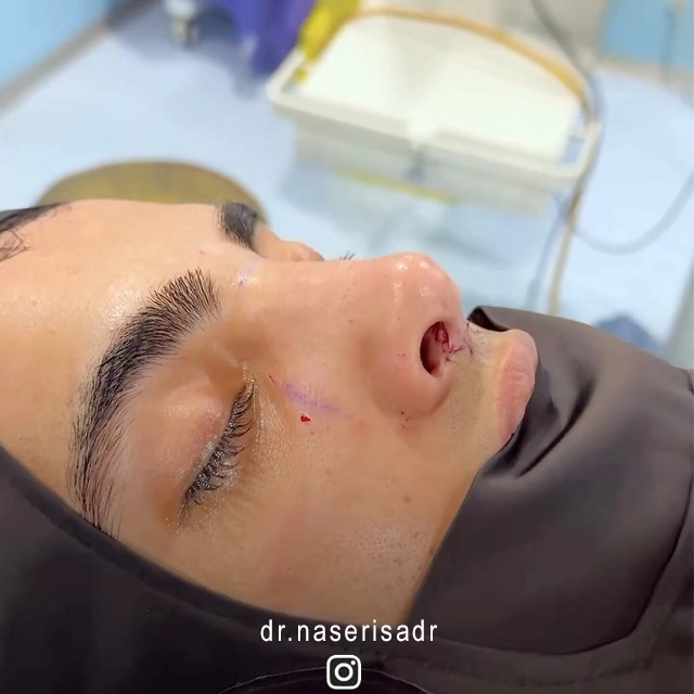 نمونه عمل بینی به روش پیزوسرجری