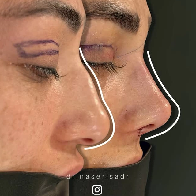 نمونه کار جراحی بینی به روش پیزوسرجری