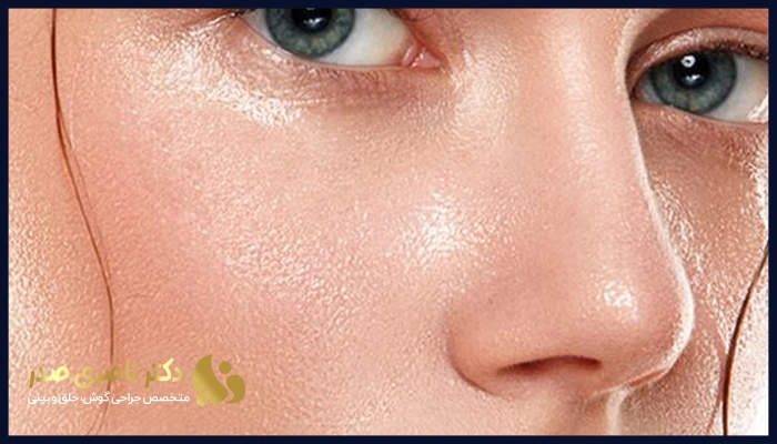 روشهای درمان چرب شدن پوست بینی بعد از عمل